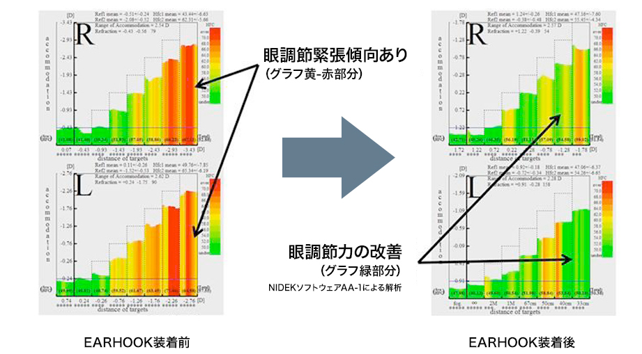 EARHOOK装着前 眼調節緊張傾向あり（グラフ黄-赤部分） EARHOOK装着後 眼調節力の改善（グラフ緑部分）NIDEKソフトウェアAA-1による解析